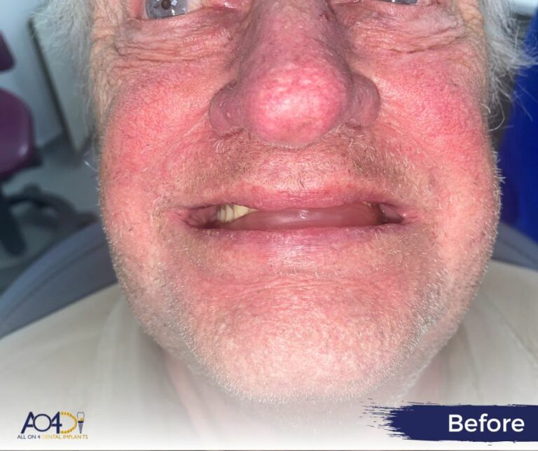 Upper Jaw All On 4 Dental Implants Case Study – All On 4 Dental Implants